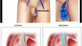 Κιρσοκήλη: Αίτια – Διάγνωση – Θεραπεία
