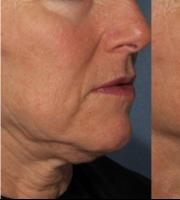 Vita Plus Αλεξανδρούπολης: Λαιμός-Ντεκολτέ: Η περιοχή που προδίδει την ηλικία; ΟΧΙ πια!