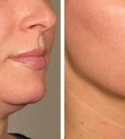 Vita Plus Αλεξανδρούπολης: Λαιμός-Ντεκολτέ: Η περιοχή που προδίδει την ηλικία; ΟΧΙ πια!