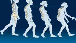 Σήμερα η Παγκόσμια Ημέρα Οστεοπόρωσης.