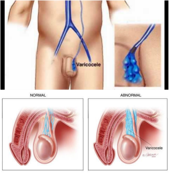 Κιρσοκήλη: Αίτια – Διάγνωση – Θεραπεία
