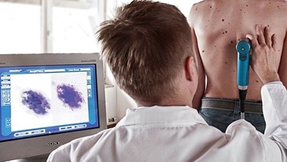 5 Μαΐου: Ευρωπαϊκή Ημέρα Μελανώματος